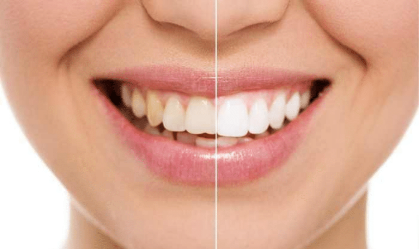 teeth whitening