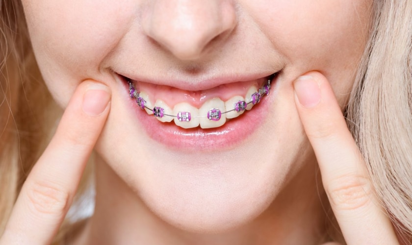 Orthodontics - Custer Creek Dental Care - Dentist McKinney