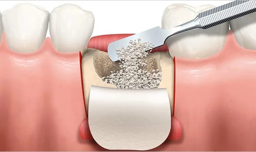 Image of bone grafting-understanding bone grafting in dental implants procedures
