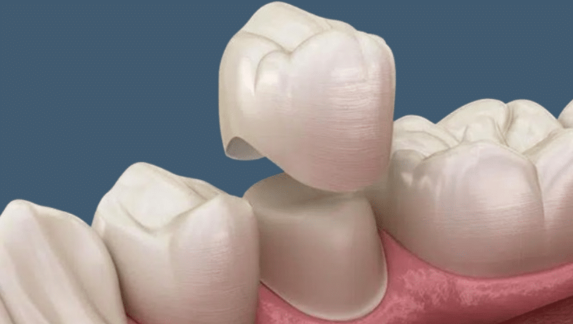 Dental Crowns Fix Gaps Between Teeth