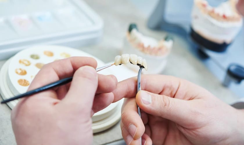 Porcelain Bridges - Custer Creek Dental Care - Dentist McKinney