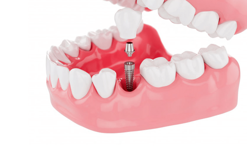 How Much Do Dental Implants Really Cost
