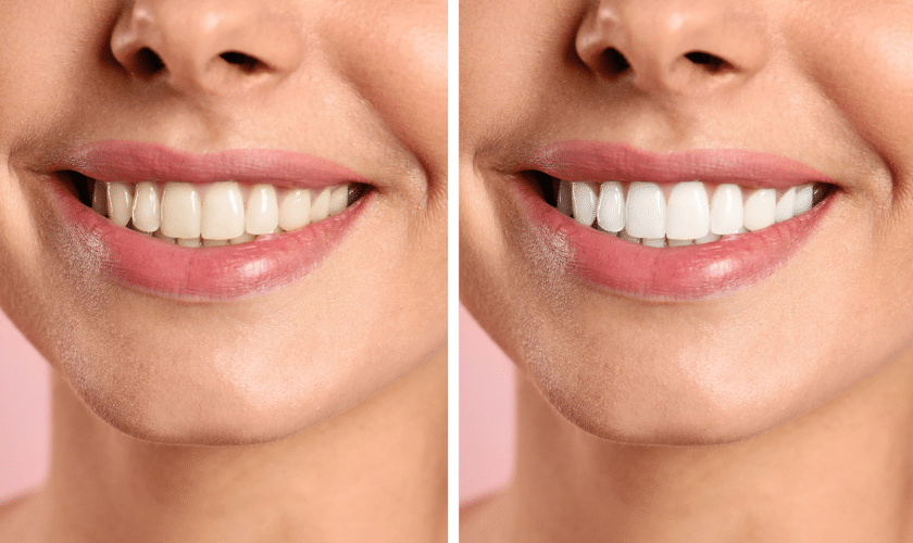 How Can I Maximize My Teeth-whitening Results