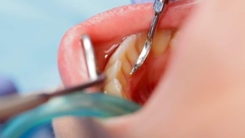 removing dental cement from porcelain crowns