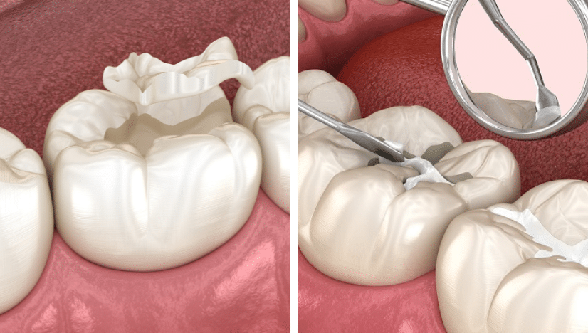 what to eat and avoid after dental sealant treatment