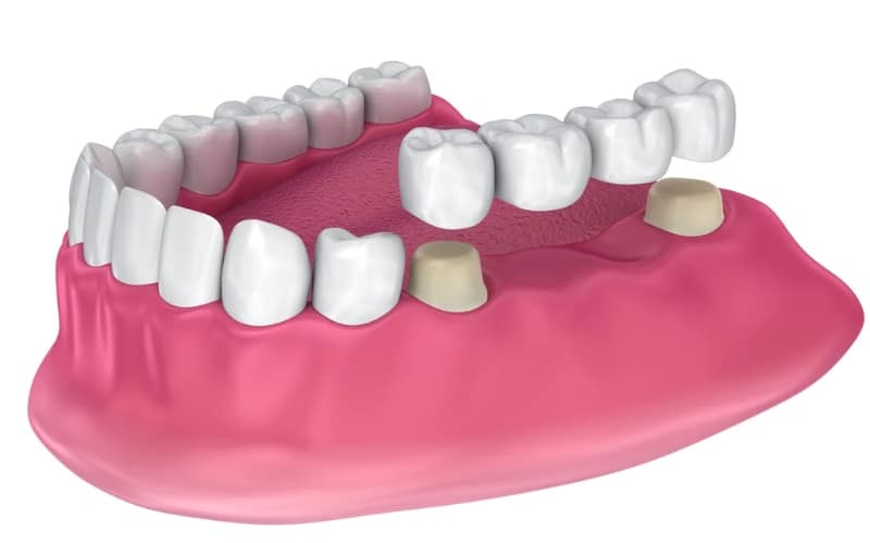 Top Myths About Dental Bridges Debunked