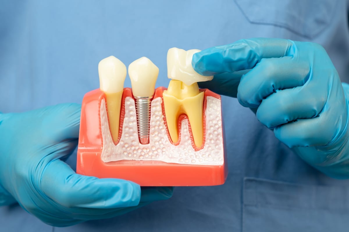 Dental Crowns in McKinney